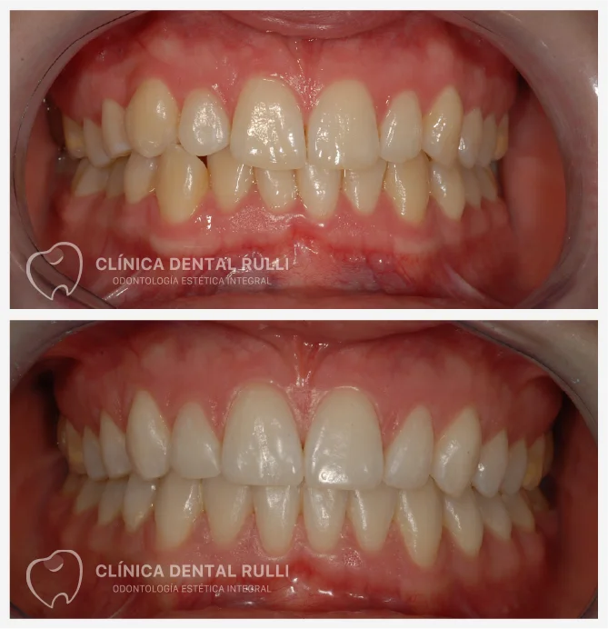 Clinica dental Rulli Casos de Éxito Clase III Esquelética