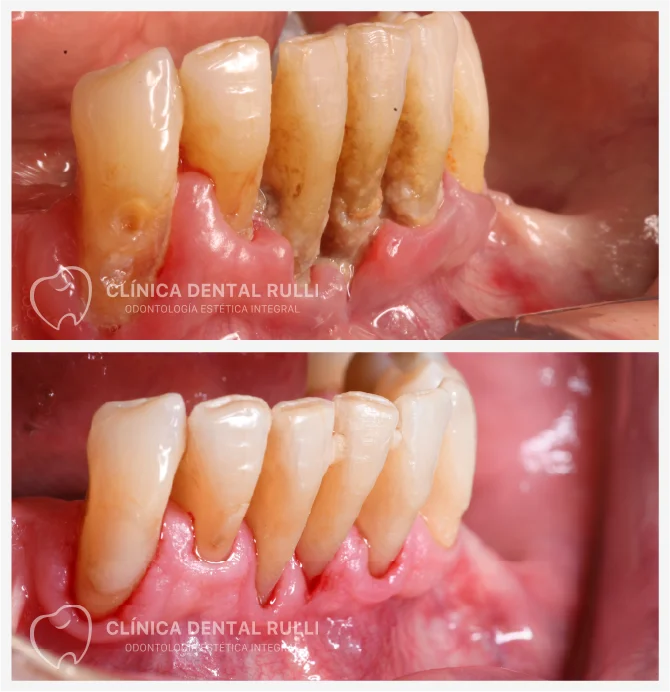 Clinica dental Rulli Casos de Éxito Periodoncia