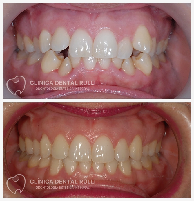 Clinica dental Rulli Casos de Éxito Ortodoncia