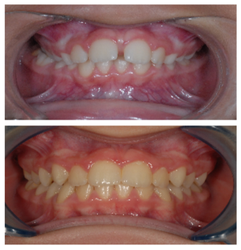 Clinica dental Rulli Casos de Éxito Ortodoncia